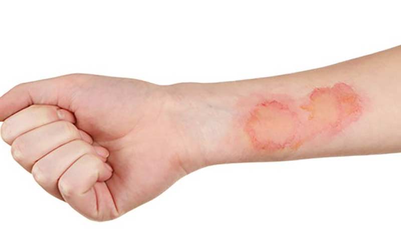 سوختگی پوست، علائم و درمان